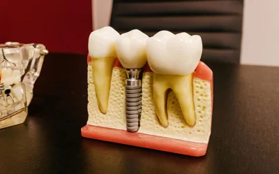 Biocompatible Titanium Implants